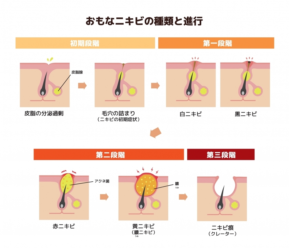 【医師監修】あごニキビの原因は？　Uゾーンのニキビケア方法とは