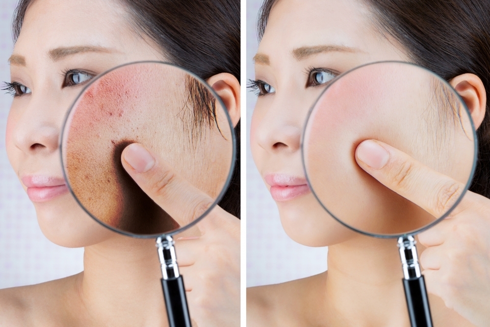 【医師監修】ニキビ跡の赤みをケアする方法は？　レーザーは必要？