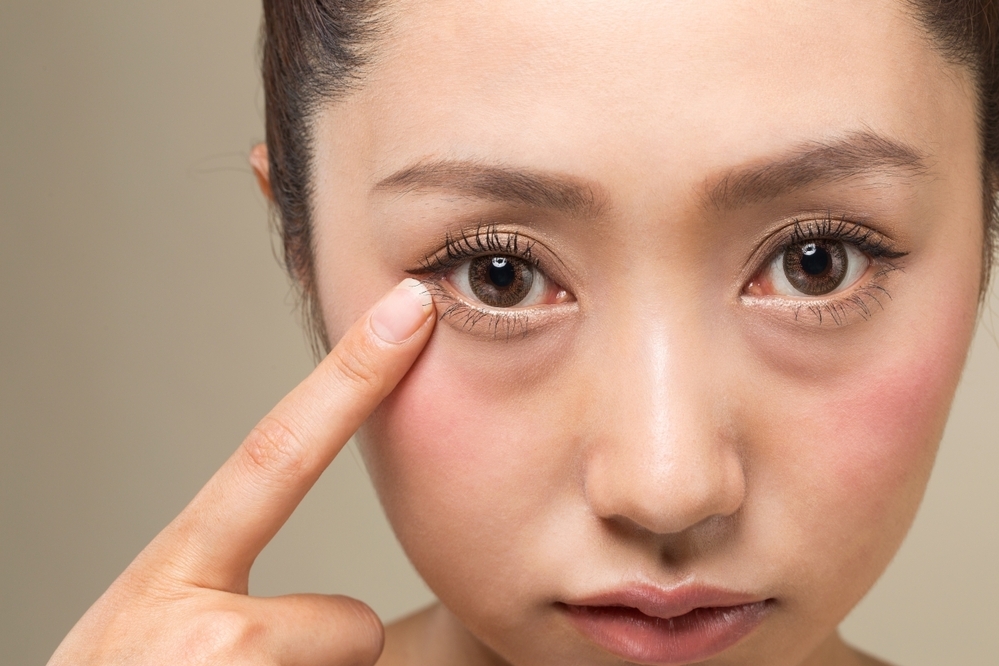 【医師監修】目のクマをなんとかしたい！　クマは種類別に解消していこう