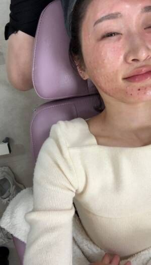 「ニキビ肌から理想の美肌に！」韓国美容インフルエンサーNanaさんに施術体験インタビュー