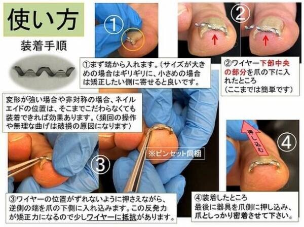 専門医師が開発した巻き爪矯正器具「ネイルエイド」で2万人以上の「巻き爪難民」を救済！　～10人に1人が悩んでいる「巻き爪」、治療費は自費負担で高額～