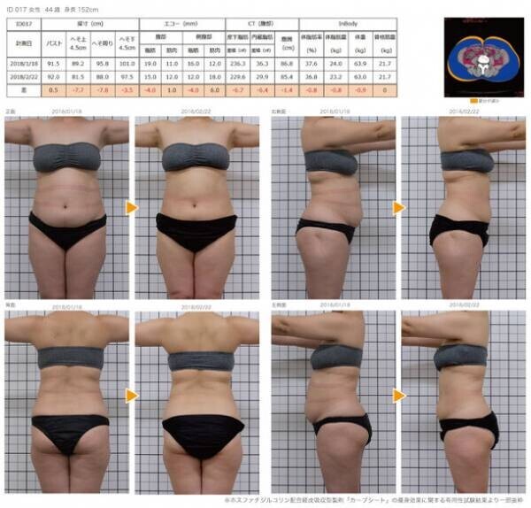 ユニッシュ、就寝中に貼るだけで痩身効果が得られる「ホスファチジルコリン経皮吸収製剤」の開発で国内特許を取得！～脂肪分解注射メソセラピーの代替法～