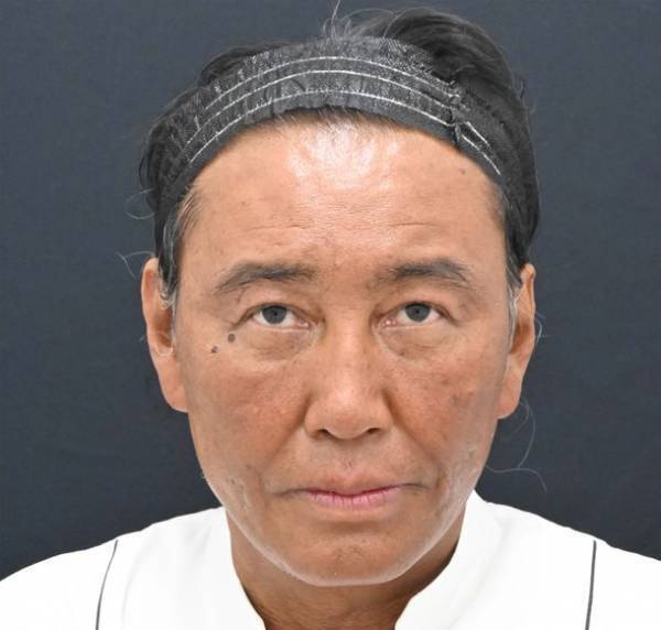 たいめいけん茂出木シェフが総額300万円超の若返り整形！SBC湘南美容クリニック秋葉原院の名倉 俊輔医師が執刀