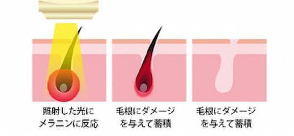 1台で顔からVIOまでツルつや艶肌！全身のムダ毛は一切いらない！家庭用光美容器『ZALAXY ENBI -艶美-』予約販売開始