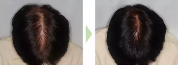 発売20周年を迎えた女性用育毛剤『リリィジュ』から世界初※1の冷却育毛剤『薬用リリィジュ 冷感育毛エッセンス』を新発売