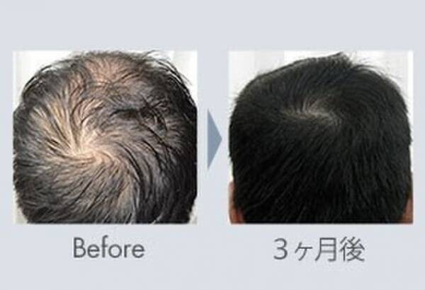 ＜発毛専用サロン部門2冠達成！＞脅威の98.2％の発毛率を実現する発毛サロン日本で唯一の発毛サロン(R)「BIDAN」、「BIDAN明石店」が7/8で移転8周年を迎えます！！