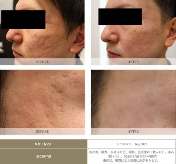 【ニキビ跡クレーター治療に希望の光】取扱い医院希少の新治療法『はなふさ式ニキビ跡治療』で、難しいニキビ跡クレーターの治療が可能に