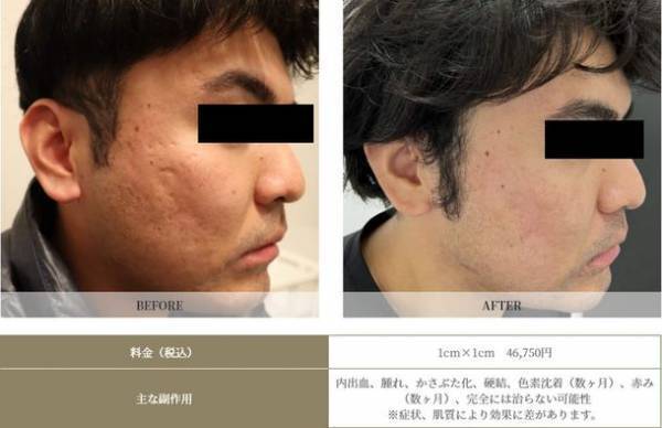 【ニキビ跡クレーター治療に希望の光】取扱い医院希少の新治療法『はなふさ式ニキビ跡治療』で、難しいニキビ跡クレーターの治療が可能に