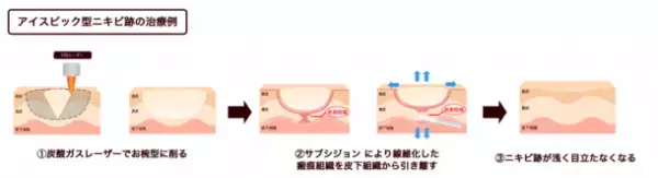 【ニキビ跡クレーター治療に希望の光】取扱い医院希少の新治療法『はなふさ式ニキビ跡治療』で、難しいニキビ跡クレーターの治療が可能に