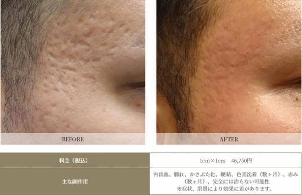 【ニキビ跡クレーター治療に希望の光】取扱い医院希少の新治療法『はなふさ式ニキビ跡治療』で、難しいニキビ跡クレーターの治療が可能に