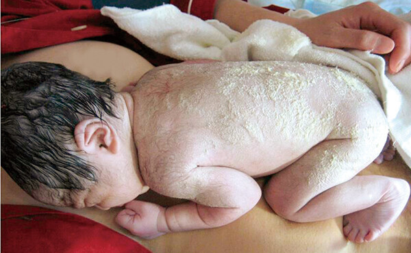 出生早期から1歳まで「ママ＆キッズ 」製品を指導したスキンケア方法のもと使用した乳児において、卵白に感作している児も含めアトピー性皮膚炎・食物アレルギーの発症率は極めて少ないという研究結果を発表