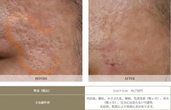 “ニキビ跡の最後の砦に”花房式ニキビ跡治療を提供する『はなふさ皮膚科 京都院』が2月1日にOPEN