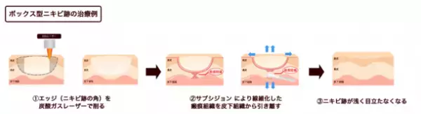 “ニキビ跡の最後の砦に”花房式ニキビ跡治療を提供する『はなふさ皮膚科 京都院』が2月1日にOPEN