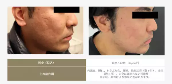 “ニキビ跡の最後の砦に”花房式ニキビ跡治療を提供する『はなふさ皮膚科 京都院』が2月1日にOPEN