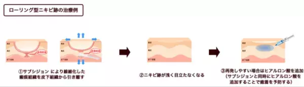 “ニキビ跡の最後の砦に”花房式ニキビ跡治療を提供する『はなふさ皮膚科 京都院』が2月1日にOPEN