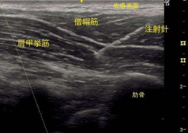 痛み治療専門の名古屋麻酔科クリニック(ペインクリニック)が2023年2月より「肩こりボトックス専門外来」を開設