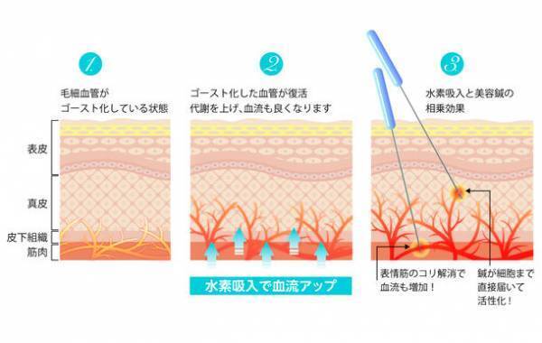 相模原市の鍼灸院「はり灸マッサージ　みなぎる美体　橋本分院」が水素吸入×美容鍼(パルス通電付き)の施術を3月1日より開始