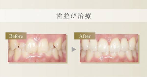 共立美容外科・歯科の「歯並び治療キャンペーン」開催　自信を持ってマスクを外せるように期間限定で対象施術料金が30％OFF！