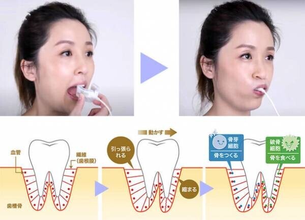 矯正期間を従来の半分以下に！早く終わらせる「光加速スピード矯正」治療を2023年8月に開始