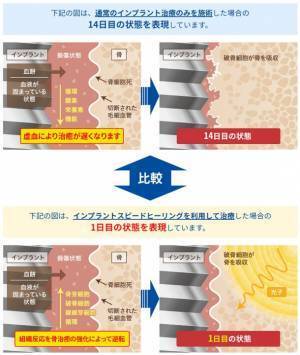 インプラント治療を早く終わらせる「光加速インプラントスピードヒーリング」治療を2023年9月に開始
