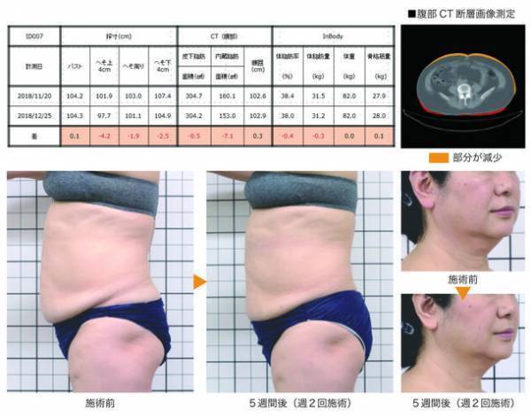 ユニッシュ、脂肪分解注射の代替法に基づくエレクトロポレーション用導入液剤の開発で国内特許を取得！