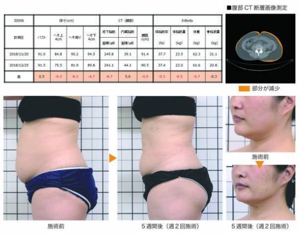 ユニッシュ、脂肪分解注射の代替法に基づくエレクトロポレーション用導入液剤の開発で国内特許を取得！