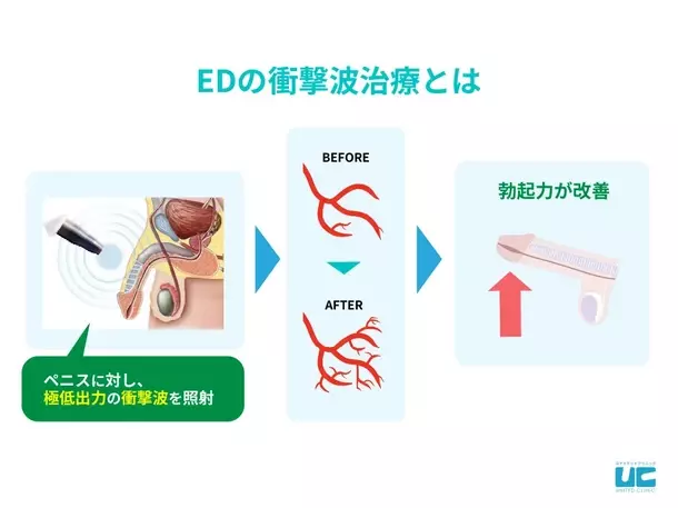 ユナイテッドクリニックグループがED衝撃波治療「レノーヴァ(RENOVA)」を導入　薬に頼らず衝撃波でEDを根本から改善