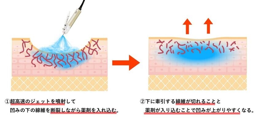 まゆりなclinic名古屋栄　ニキビ跡の凹み治療を一歩進める医療機器「キュアジェット」導入！マイクロサブシジョン施術を提供開始