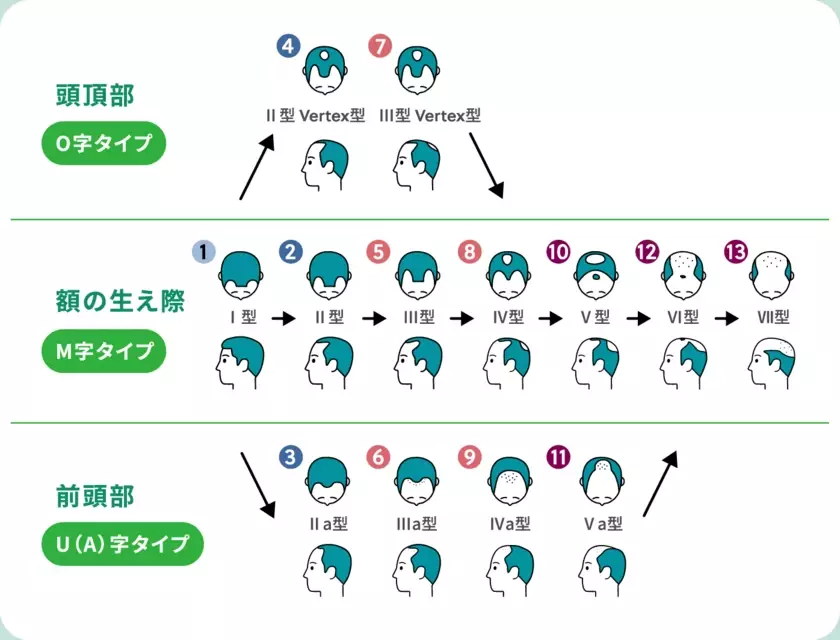 薄毛事情を探る6,000人への調査から見えたこと！？インフォグラフィックで見る！AGA(男性型脱毛症)実態調査2024を公開