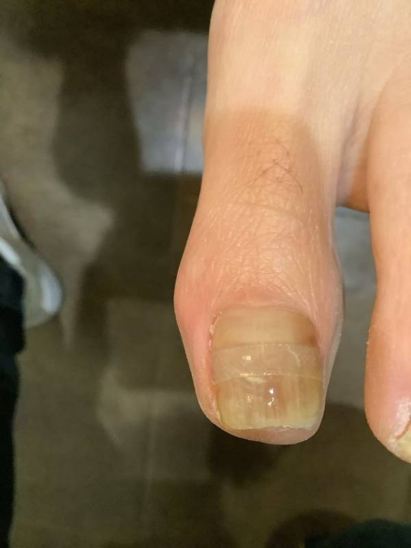 10人に1人が悩む巻き爪 もはや現代病に　「巻き爪矯正資格講習」受講者数 約2倍増