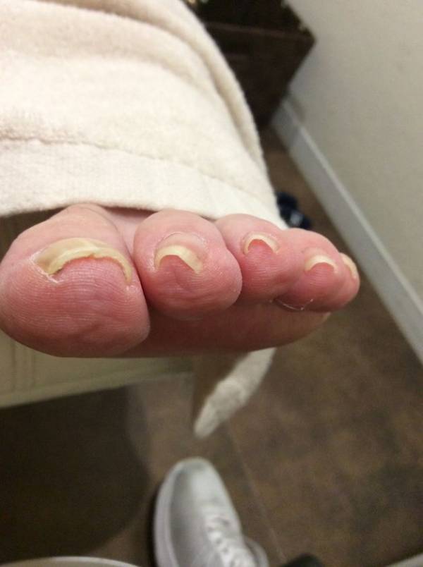 10人に1人が悩む巻き爪 もはや現代病に　「巻き爪矯正資格講習」受講者数 約2倍増