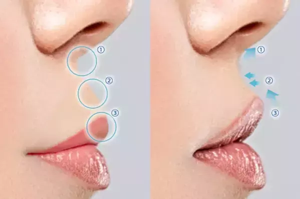 美容外科クリニック「eクリニック」が「切らない人中短縮術」を新たに全院で導入開始