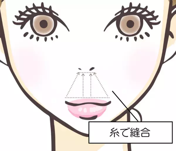 美容外科クリニック「eクリニック」が「切らない人中短縮術」を新たに全院で導入開始