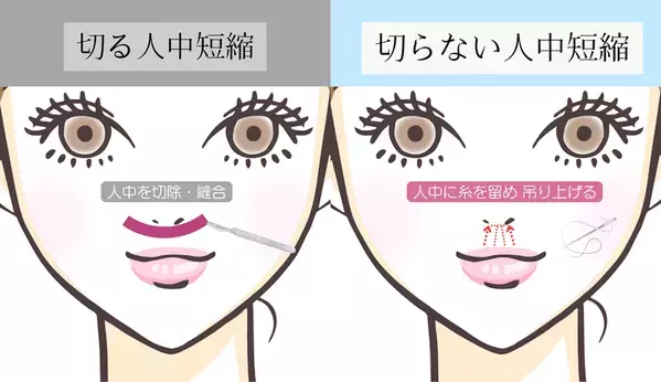 美容外科クリニック「eクリニック」が「切らない人中短縮術」を新たに全院で導入開始