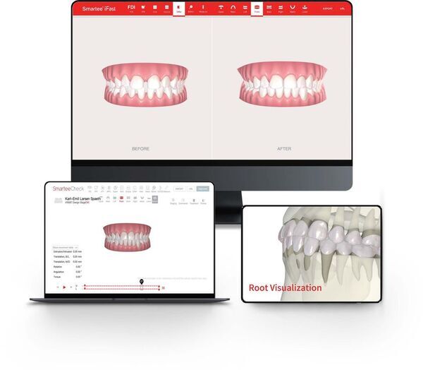 大阪矯正歯科グループ、最新のAI活用マウスピース矯正「スマーティー(Smartee)」を6月より導入