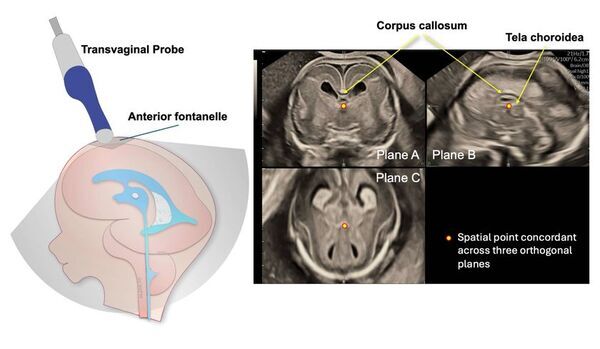 世界初・ダウン症個別化医療の扉を開く胎児脳マーカーを発見　産婦人科学分野の最高峰ジャーナルAJOGに掲載