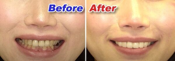 AI技術を取り入れた歯を削らない審美歯科「ルミネアーズ治療」で美しい歯と最高の笑顔を手に入れた小河麻理子さんが、世界大会でグランプリを受賞！