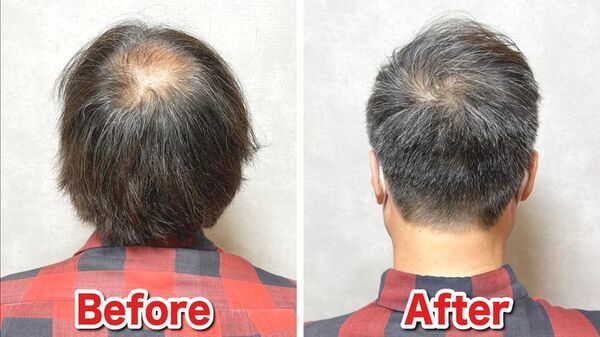 SNS再生数300万回突破！男性向け薄毛専門美容室「RELIVE」、施術ビフォーアフター事例の公式ポートフォリオを公開