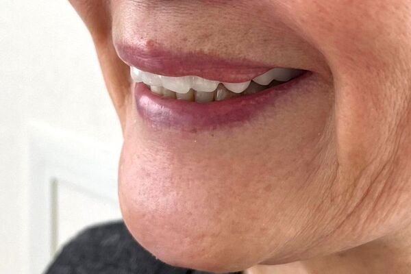 死亡率を下げる夜専用「おやすみ入れ歯」　日本初の入れ歯型マウスピースが、提供開始3年で製作数160個超え