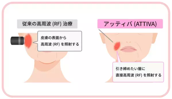 東海地方初導入　名古屋・栄で進化するたるみ治療　まゆりなclinic名古屋栄、次世代高周波治療器「ATTIVA(アッティバ)導入」