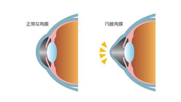 未成年の円錐角膜患者に、治療の機会を届けたい　一般社団法人円錐角膜支援の会が、角膜クロスリンキング治療費支援のためのクラウドファンディングを開始