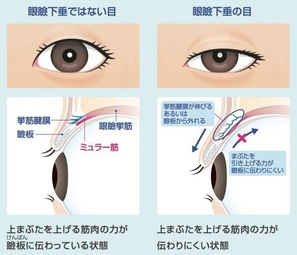 医療法人社団 岡田クリニック 眼科・緑内障・糖尿病、アップニークミニ点眼液による「眼瞼下垂」治療を開始