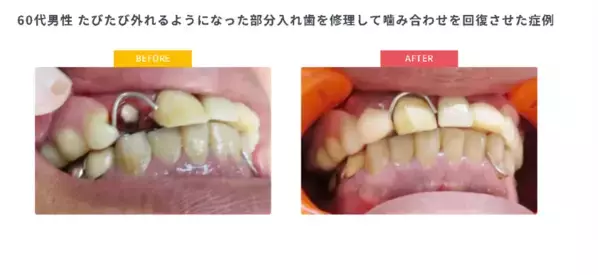 年金生活で「噛むこと」を諦める高齢者が増加「保険で作れないと思っていた」相談が毎月15件以上入れ歯保険診療「最後の駆け込み寺」が9/1相談会開始