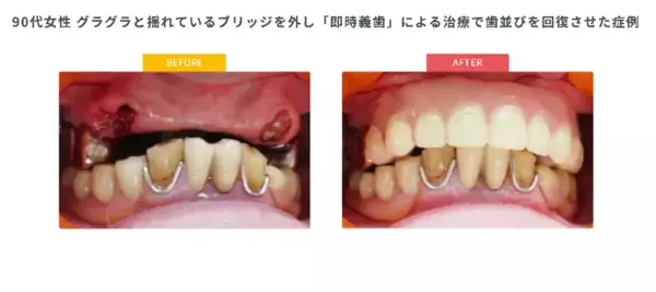 年金生活で「噛むこと」を諦める高齢者が増加「保険で作れないと思っていた」相談が毎月15件以上入れ歯保険診療「最後の駆け込み寺」が9/1相談会開始