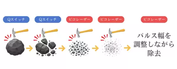 タトゥーは「消せればいい」から「できるだけ早くきれいに消したい」へ　まゆりなclinic名古屋栄が新たなタトゥー除去治療を開始