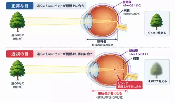 【コラム公開】10月10日は「目の愛護デー」2050年には世界の半数が近視に！子どもの近視も低年齢化　眼科専門医が解説。「近視対策に大事なオイル」とは？